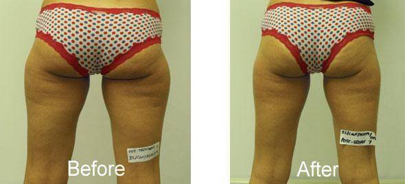 i-lipo : The Pain Free, Affordable Alternative to Liposuction