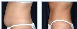 Non surgical Cellulite Reduction