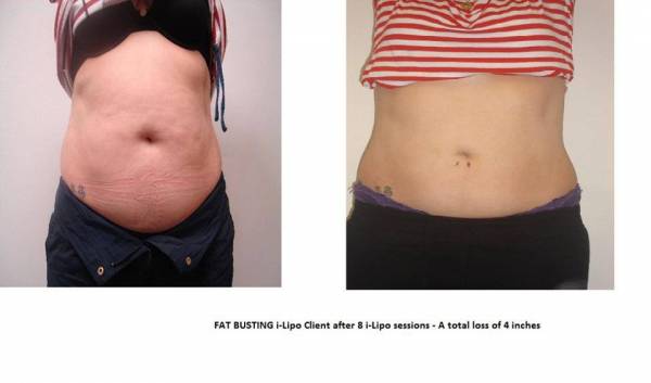 Non surgical Cellulite Reduction