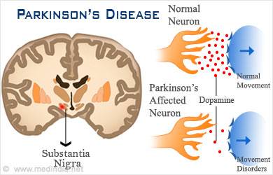 Parkinson’s Disease - More Than Just the Shakes